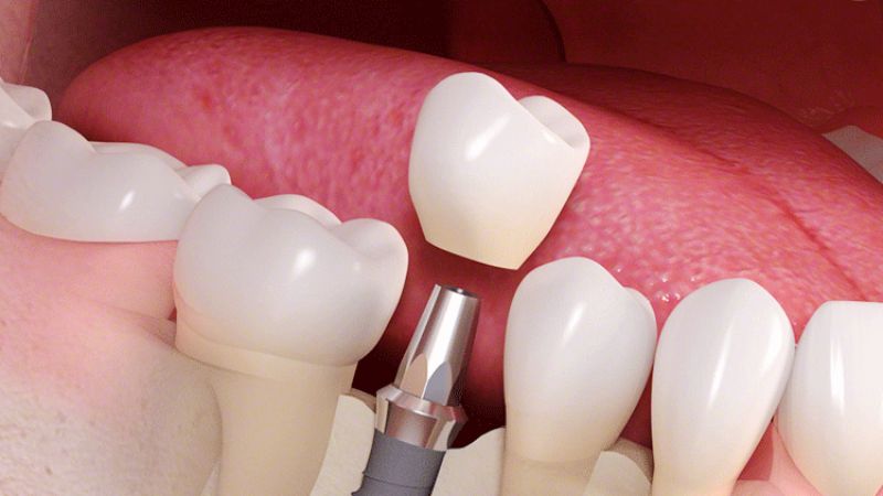 衝撃のキャンペーン：成人が今すぐ低価で始められる歯列矯正のチャンス！