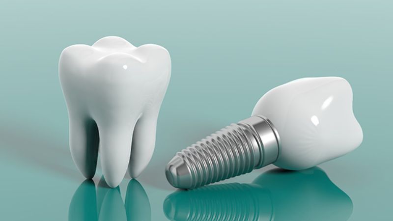 日本でお得に歯列矯正を始めるためのガイド