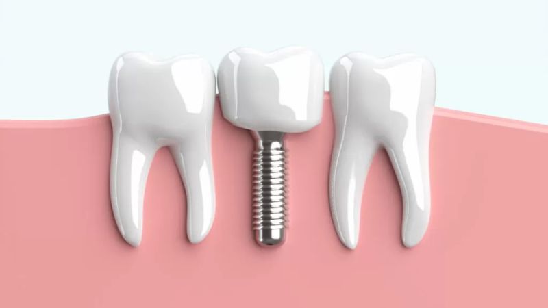 東京の衝撃価格！高品質でリーズナブルな歯科インプラントへのアクセス