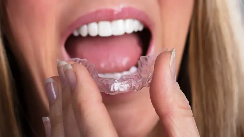 Invisible Braces: Cost, Benefits, and Expert Tips for a Perfect Smile